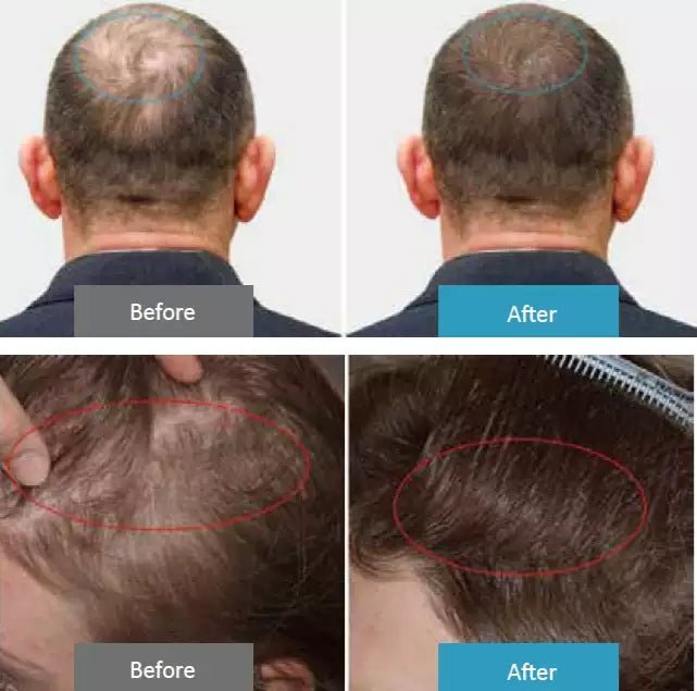 HD - CurePro - Handheld Compound Laser Device for Pain Relief and Hair Growth - Uno Vita AS