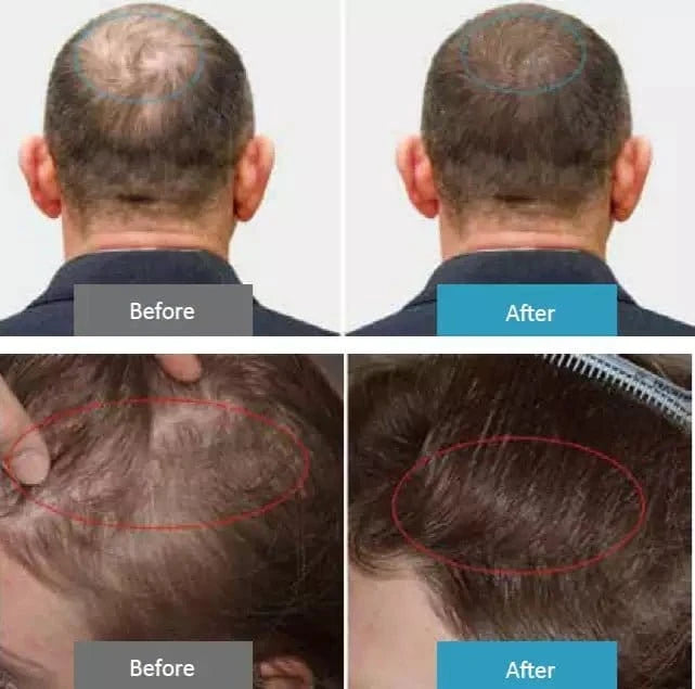 HD - CurePro - Handheld Compound Laser Device for Pain Relief and Hair Growth - Uno Vita AS