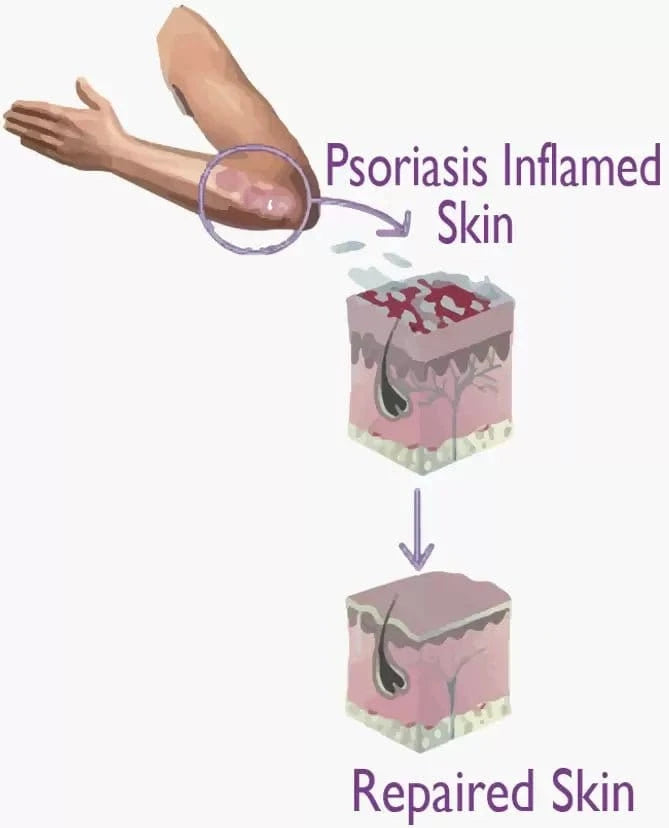 OLIVIE DERMAPSORIA - Fight Psorasis and Eczema NATURALLY! - Uno Vita AS