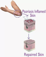 OLIVIE DERMAPSORIA - Fight Psorasis and Eczema NATURALLY!