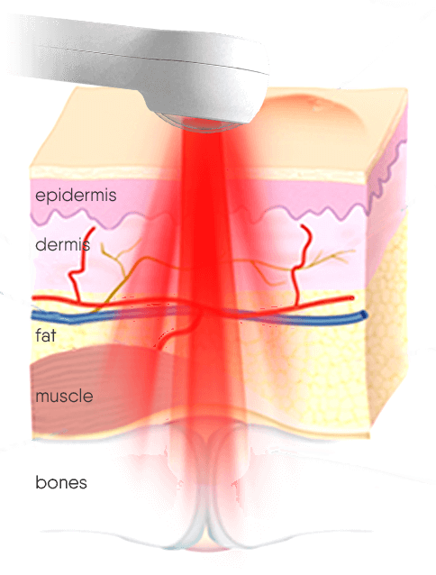 Power Cure Pro Laser