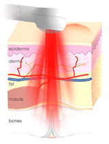 Power Cure Pro Laser