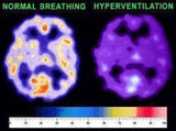 Carbogen inhaler (Co2 breathing) - Carbogenetics - Uno Vita AS